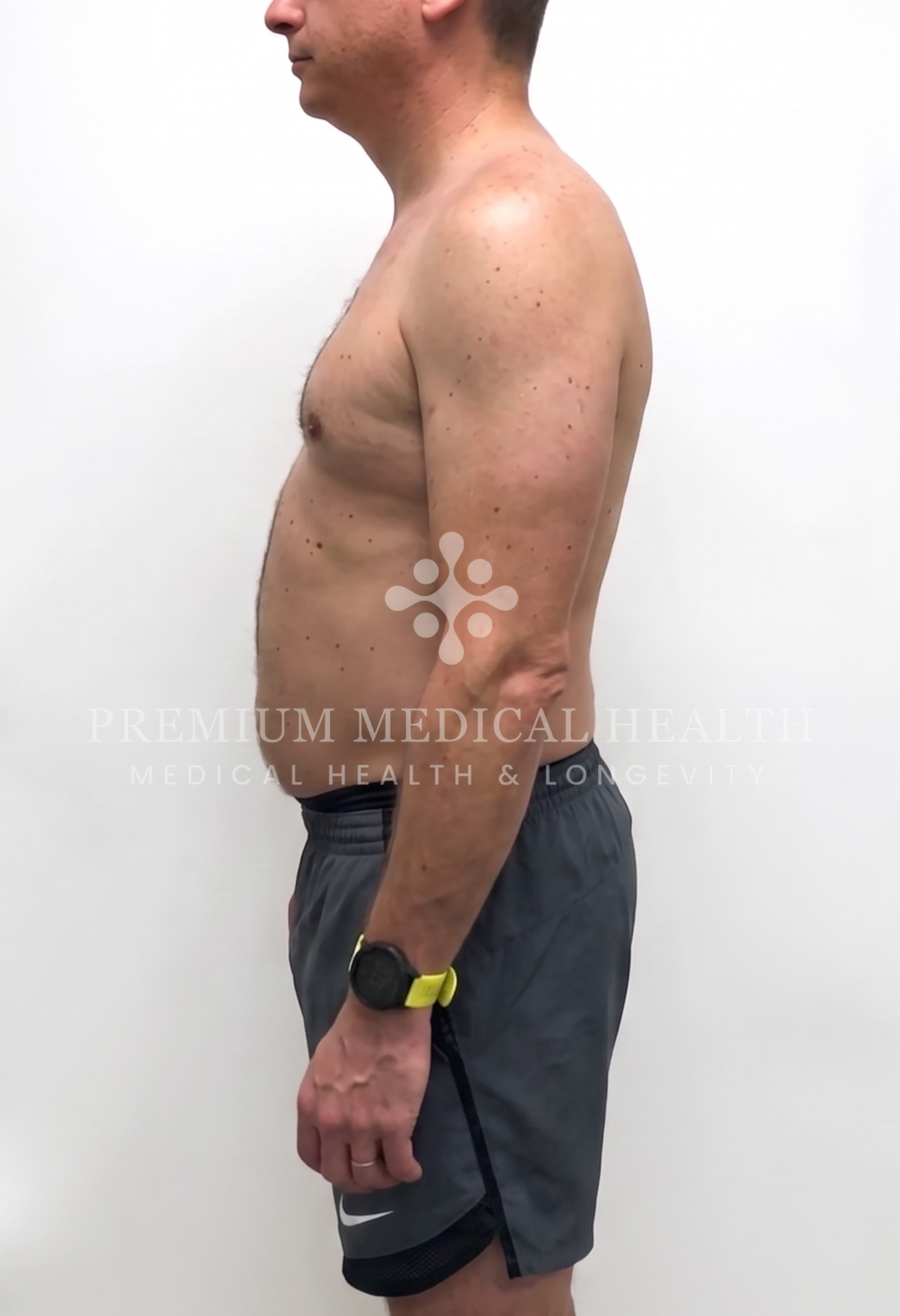 Mark, lateral baseline