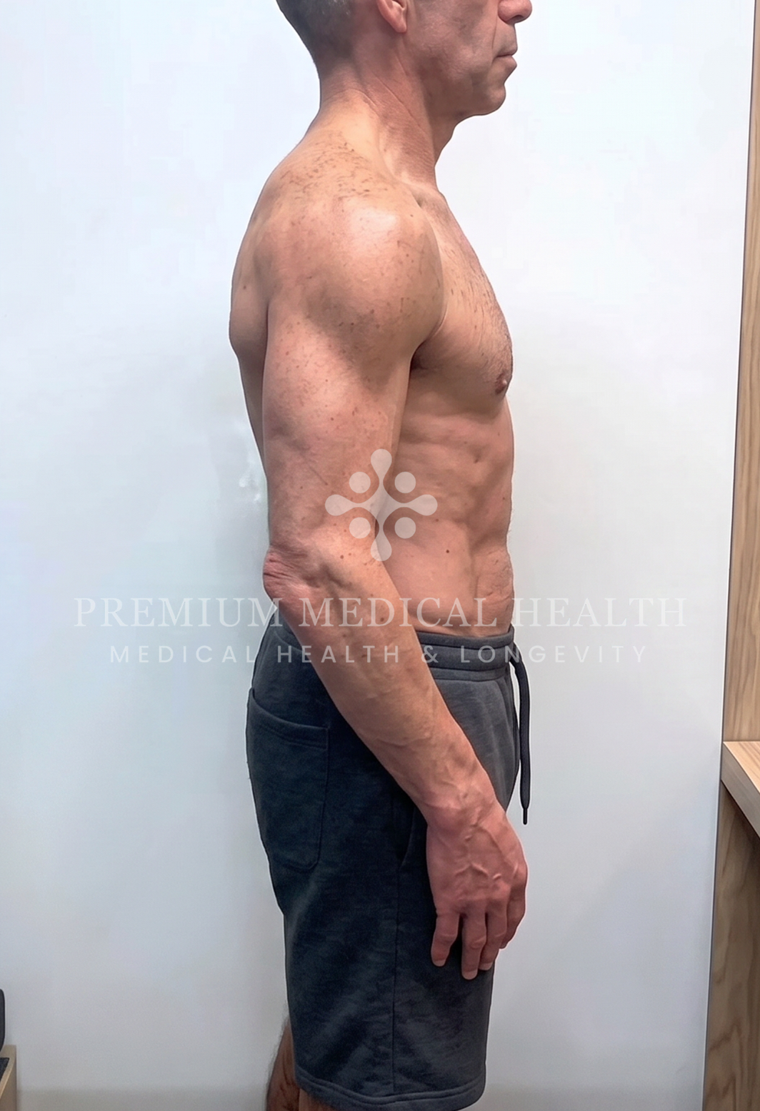 Alexandre, lateral post-protocol