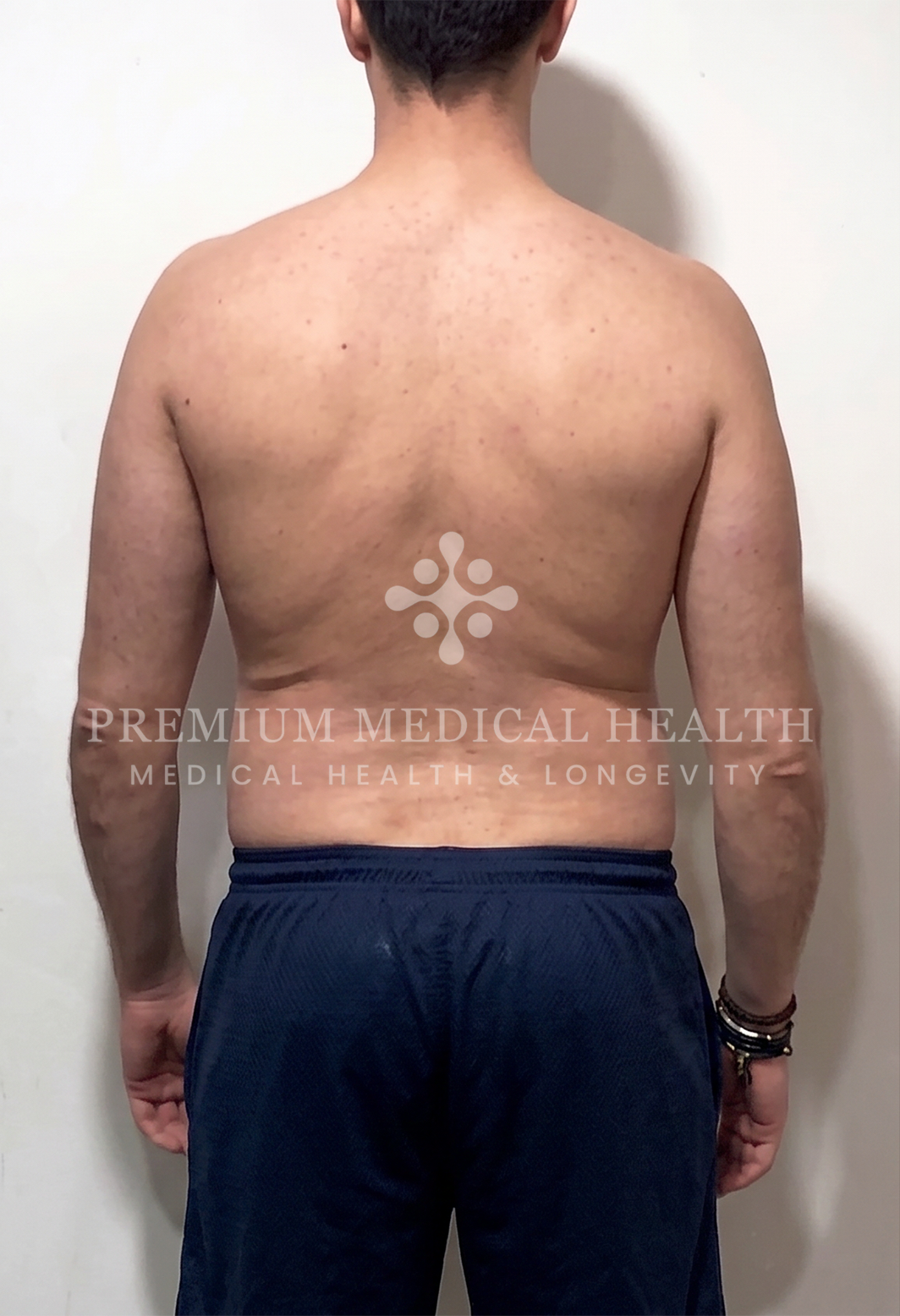Ahmed, posterior baseline