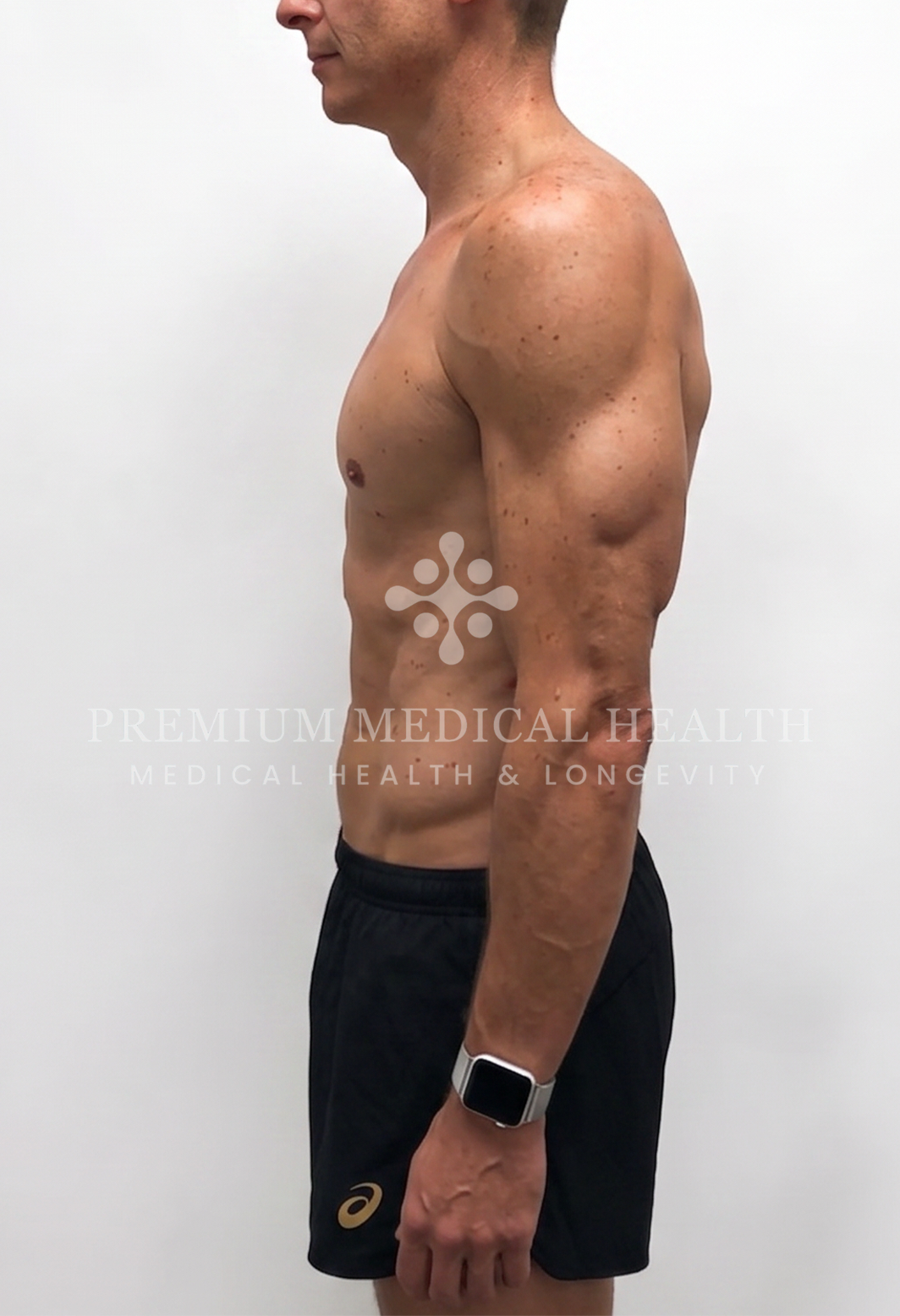 Mark, lateral post-protocol