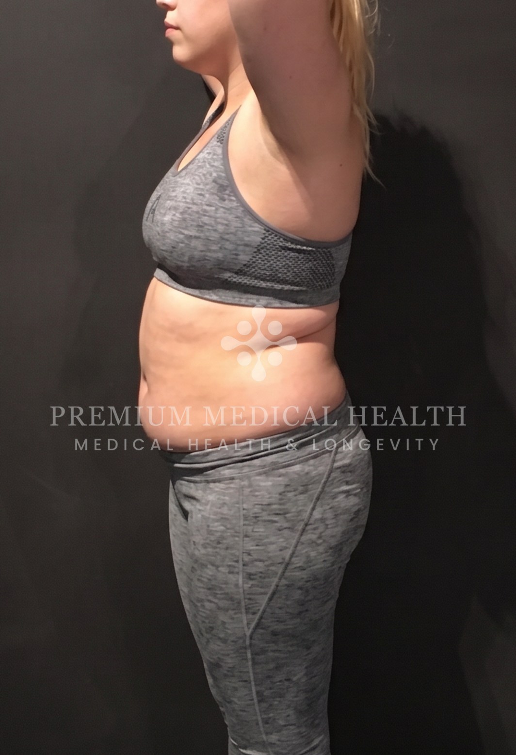 Chloe, lateral baseline